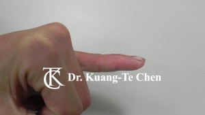 鎚狀指 Fig 3