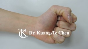 鎚狀指 Fig 5