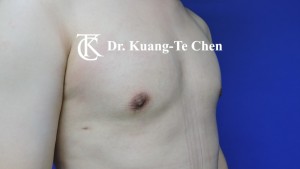 男性女乳症手術術後 陳廣得專業整形12