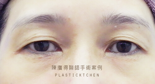 割雙眼皮
