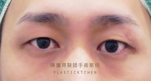 割雙眼皮