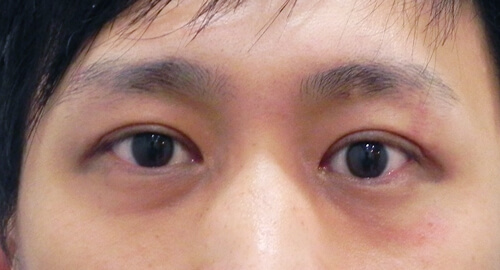 割雙眼皮