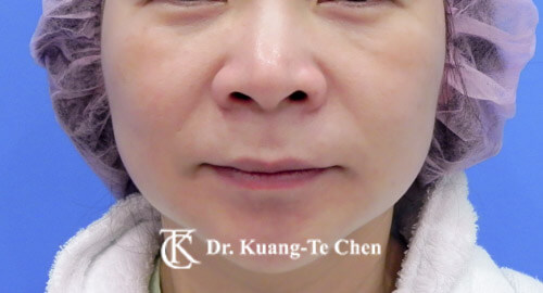 蘋果肌補脂