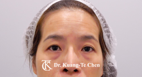 前額夫妻宮補脂