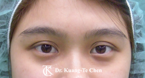 淚溝補脂