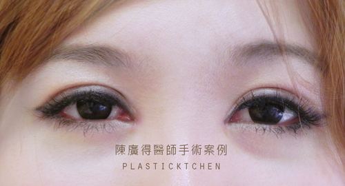 縫雙眼皮
