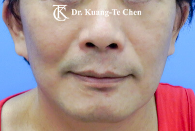 中下臉拉皮推薦