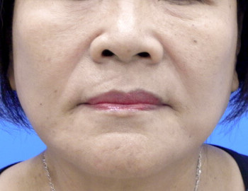 中下臉拉皮醫生