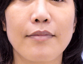 自體脂肪補脂法令紋