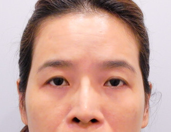 前額夫妻宮補脂