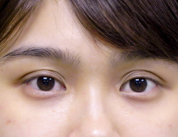 淚溝補脂