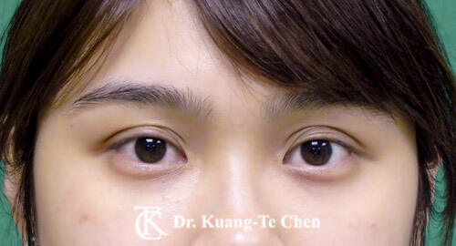 淚溝補脂