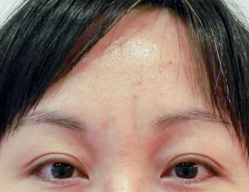 前額拉皮_皺紋
