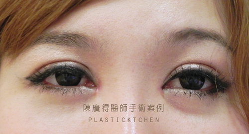 縫雙眼皮