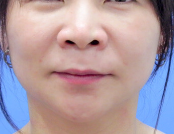 蘋果肌補脂