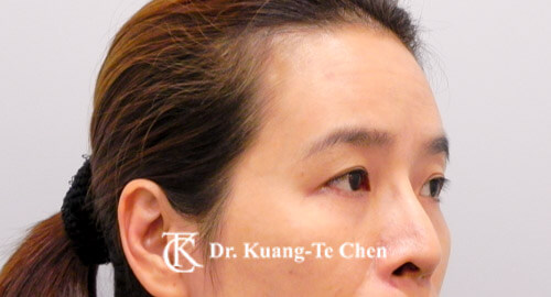 前額夫妻宮補脂