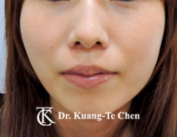 臉頰凹陷豐頰