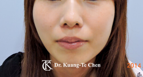 臉頰凹陷豐頰