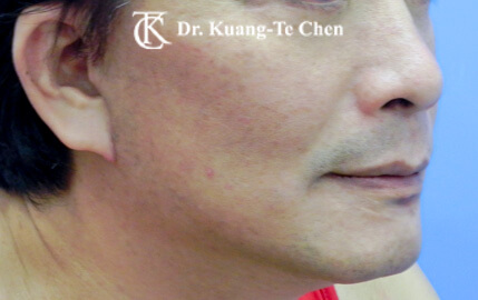 中下臉拉皮推薦