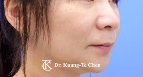 蘋果肌補脂