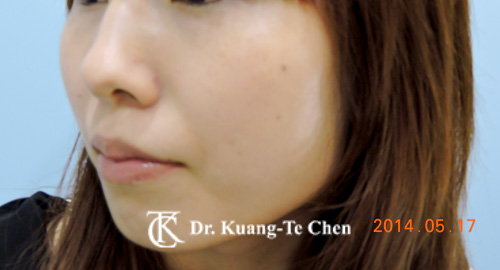 臉頰凹陷豐頰