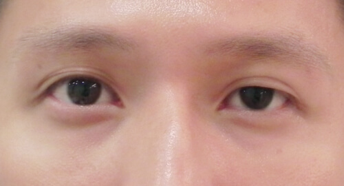 提眼瞼肌