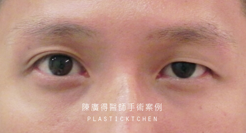 提眼瞼肌