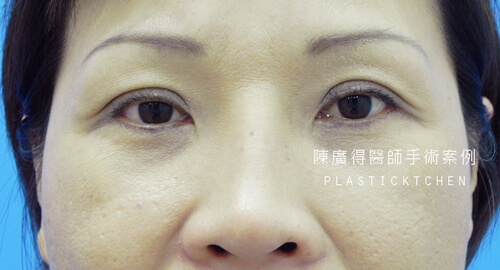 兩段式隆鼻