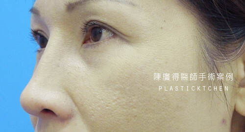 兩段式隆鼻