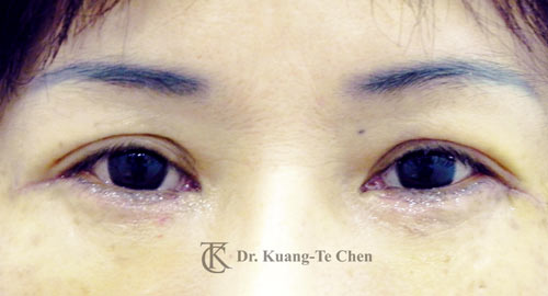 群英整形_眼袋外開_陳廣得