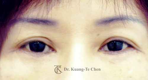 群英整形_眼袋外開_陳廣得