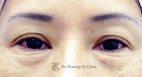 群英整形_眼袋外開_陳廣得