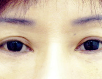 群英整形_眼袋外開_陳廣得