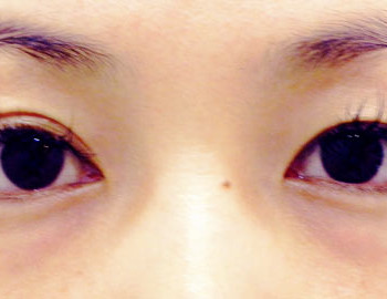 眼袋淚溝