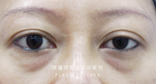 提眼瞼肌