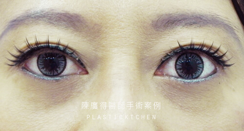 提眼瞼肌