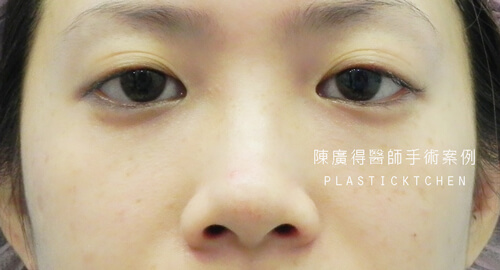 兩段式隆鼻