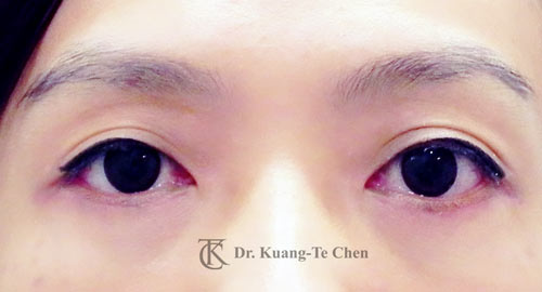 群英整形_眼袋外開_陳廣得
