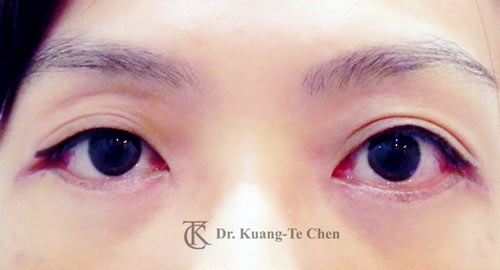 群英整形_眼袋外開_陳廣得