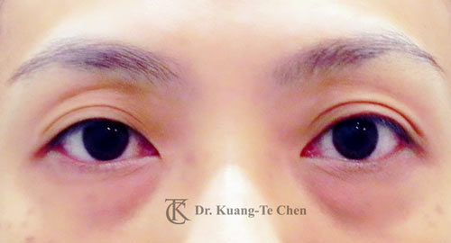 群英整形_眼袋外開_陳廣得