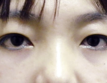 群英整形_眼袋外開_陳廣得