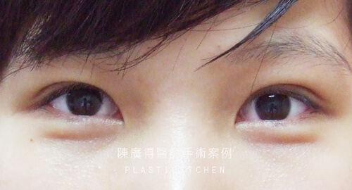 提眼瞼肌