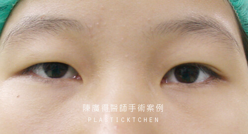 提眼瞼肌