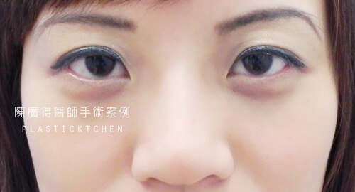 兩段式隆鼻