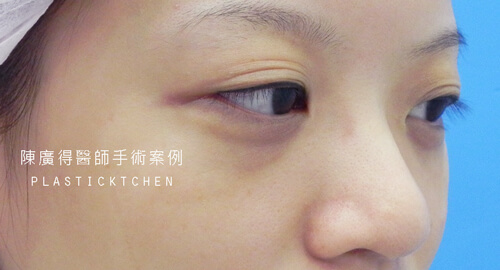 兩段式隆鼻