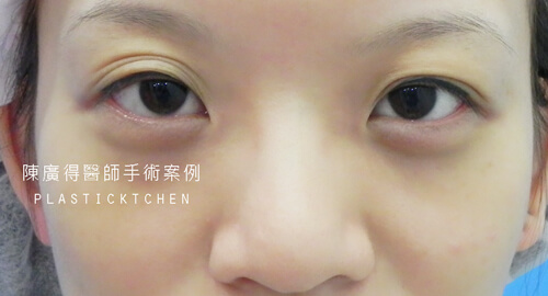 兩段式隆鼻