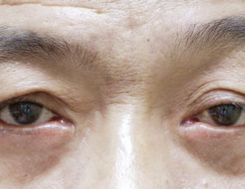 眼瞼外翻治療