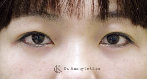 群英整形_眼袋外開_陳廣得