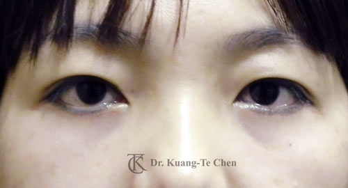 群英整形_眼袋外開_陳廣得