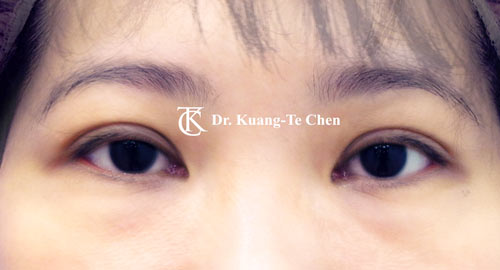 眼袋淚溝